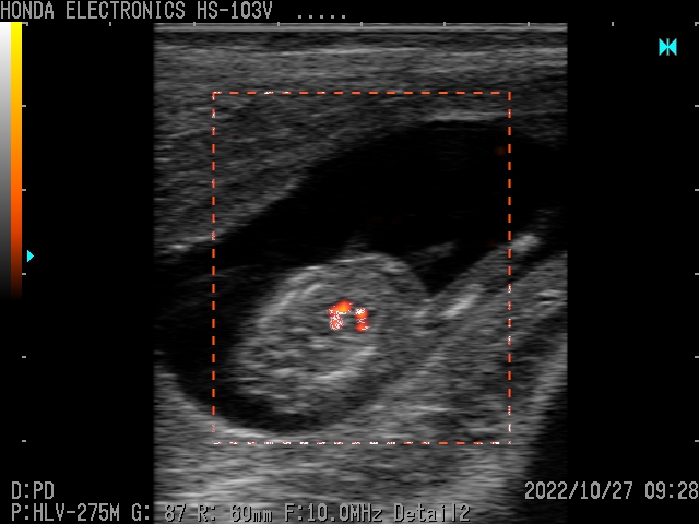 Fetal Heart