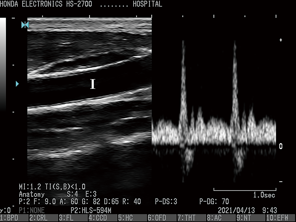 13＿3p_PW_pulse Doppler_